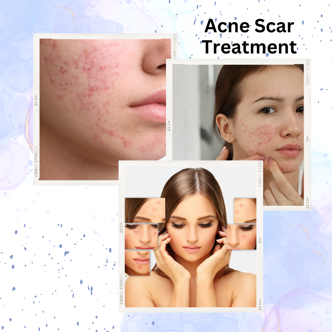 Acne Scar Treatment​