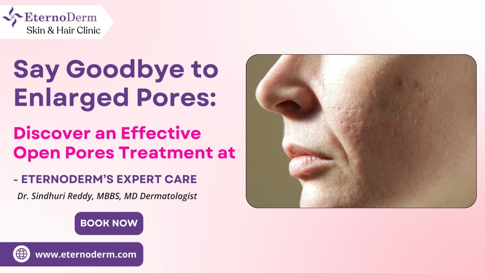 Close-up of face with enlarged open pores on cheeks, skincare treatment promotion by EternoDerm Skin & Hair Clinic.