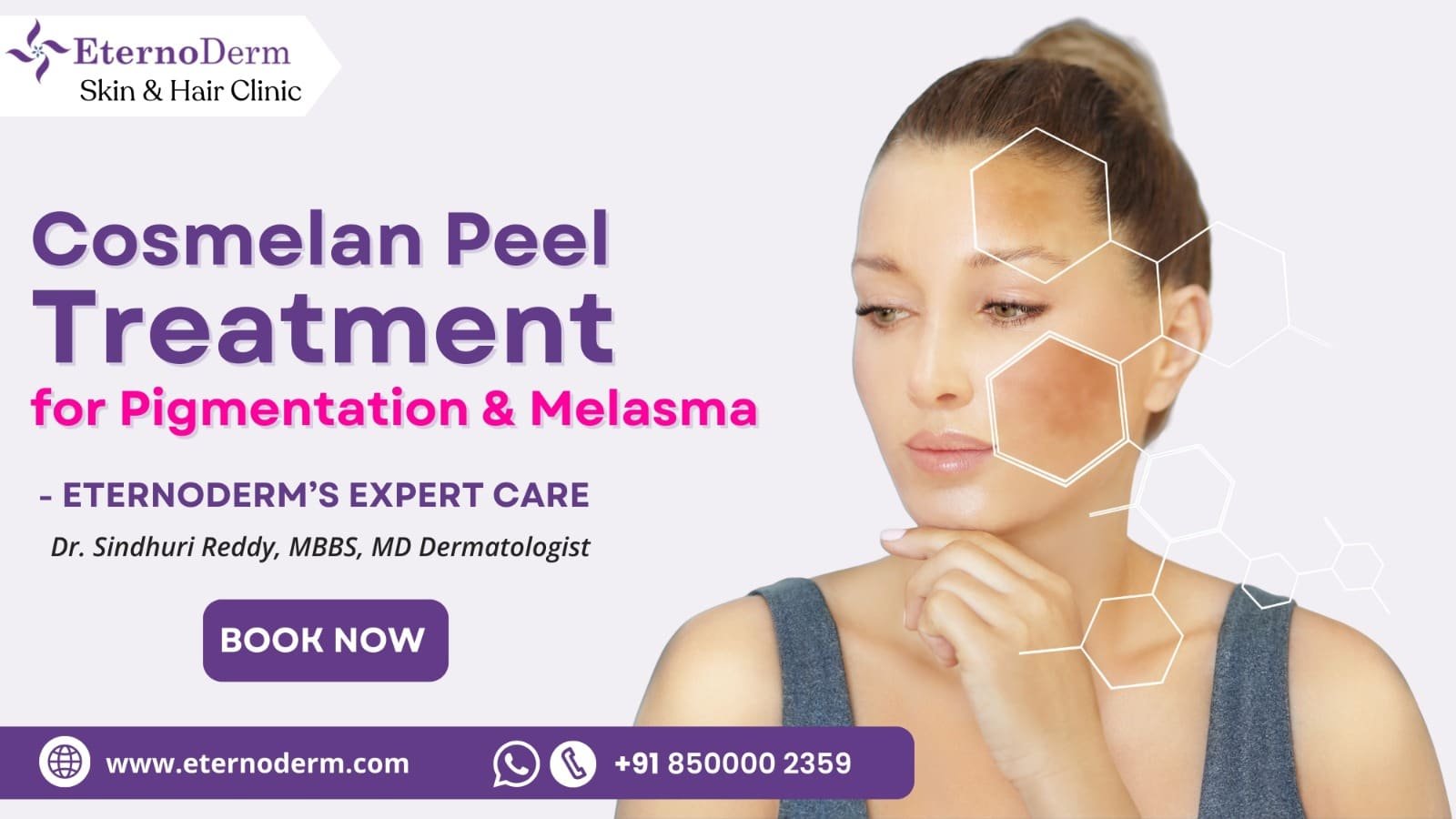 Cosmelan peel treatment for pigmentation and melasma at EternoDerm Skin and Hair Clinic Miyapur with Dr. Sindhuri Reddy