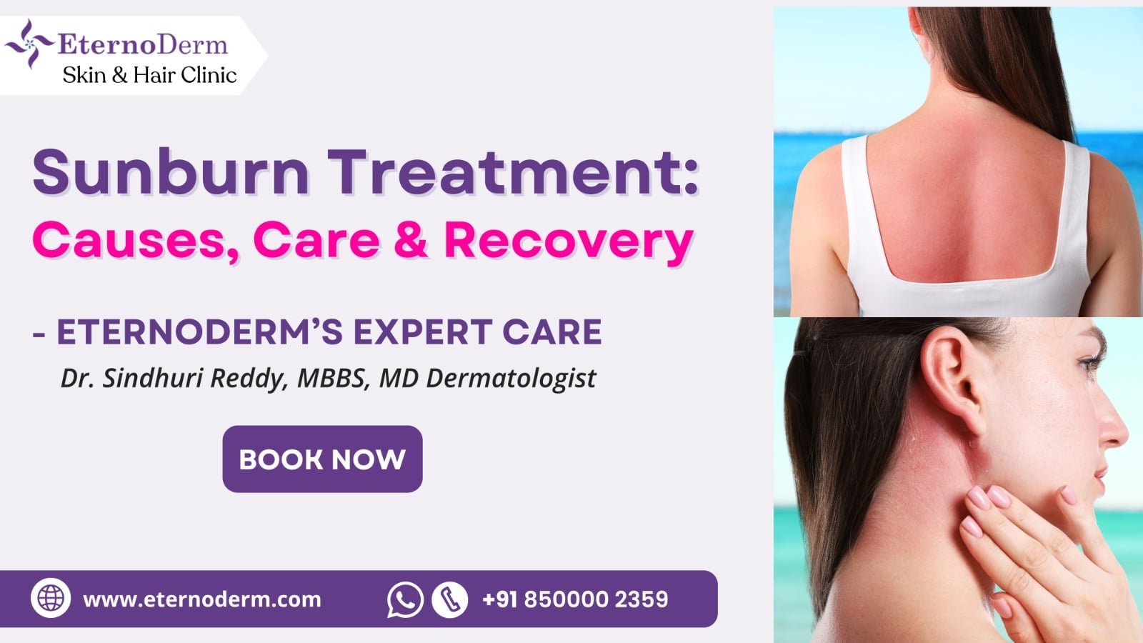 Woman with red sunburned skin on back and neck after sun exposure, sunburn treatment awareness by EternoDerm Skin & Hair Clinic.