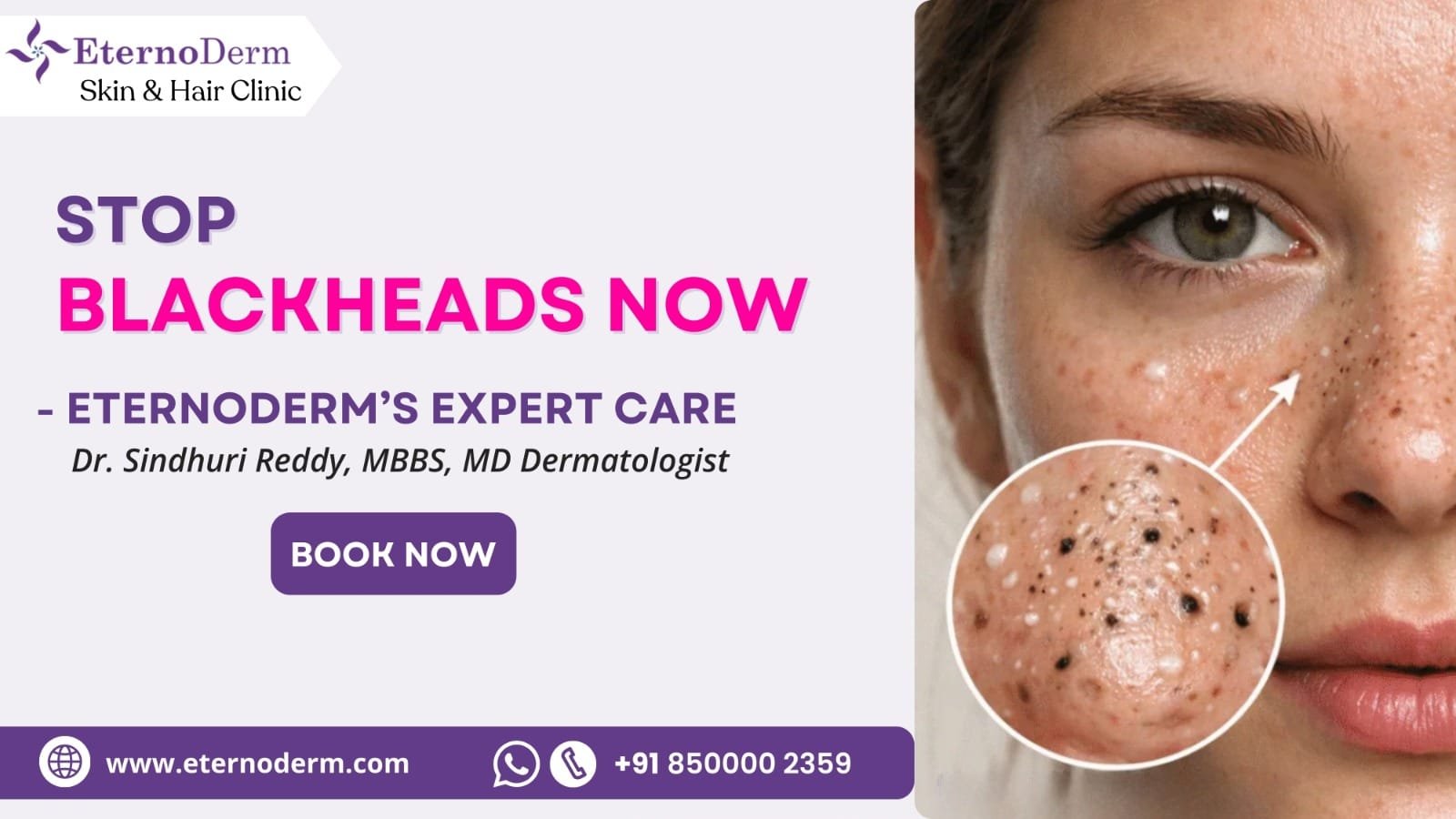 Blackhead treatment in Miyapur Hyderabad by Dr Sindhuri Reddy at EternoDerm Skin & Hair Clinic