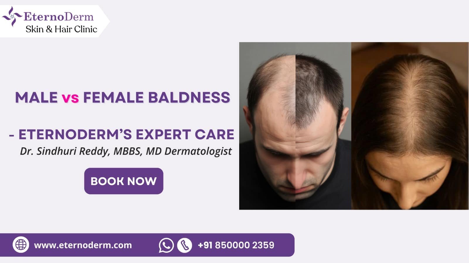 Male vs female baldness comparison treated at EternoDerm Skin & Hair Clinic Miyapur by Dr Sindhuri Reddy MBBS MD Dermatologist