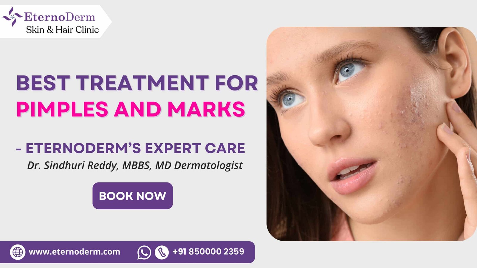 Best treatment for pimples and acne marks by dermatologist in Miyapur Hyderabad