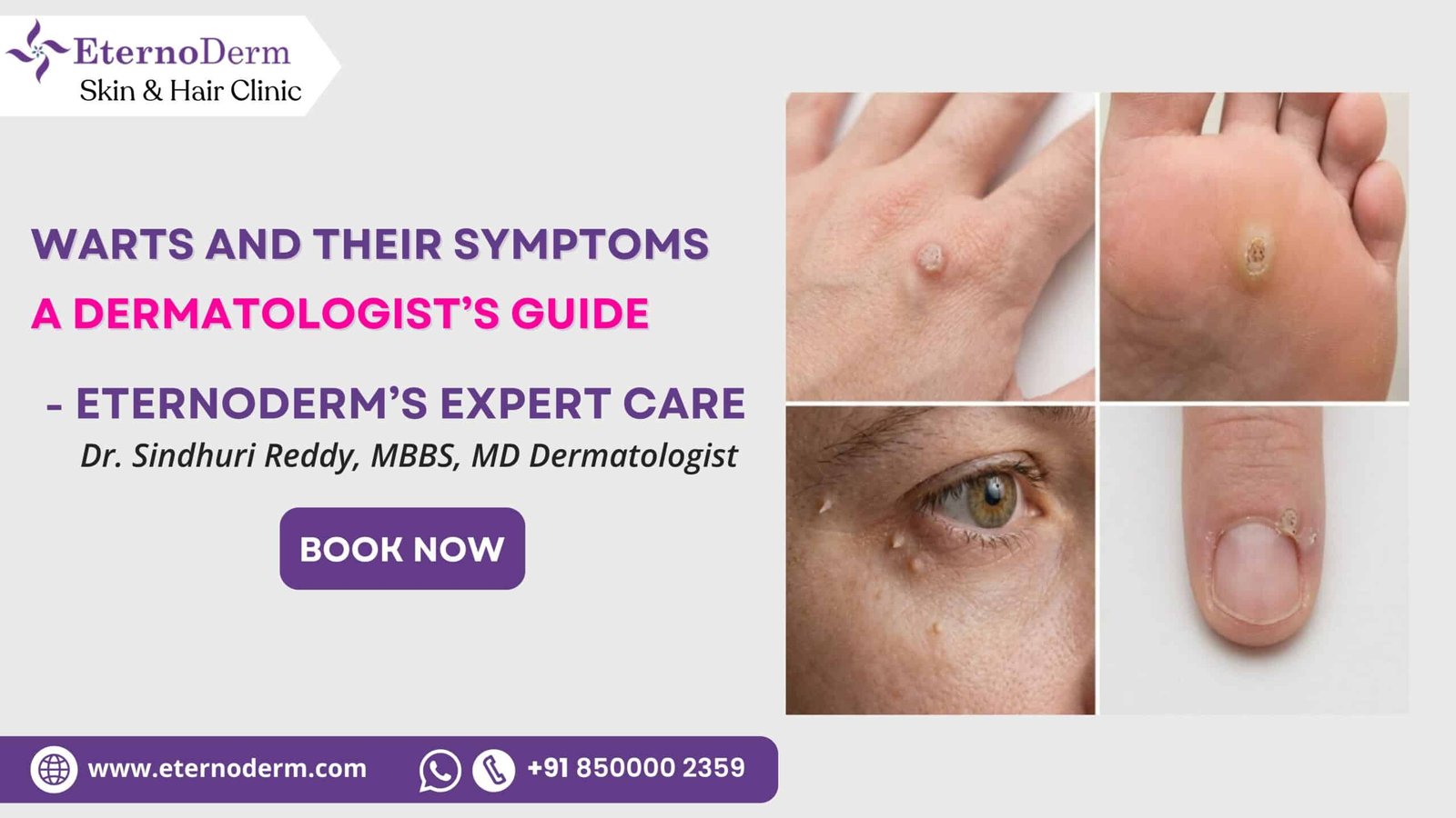 Warts treatment by dermatologist in Miyapur Hyderabad at EternoDerm Skin & Hair Clinic