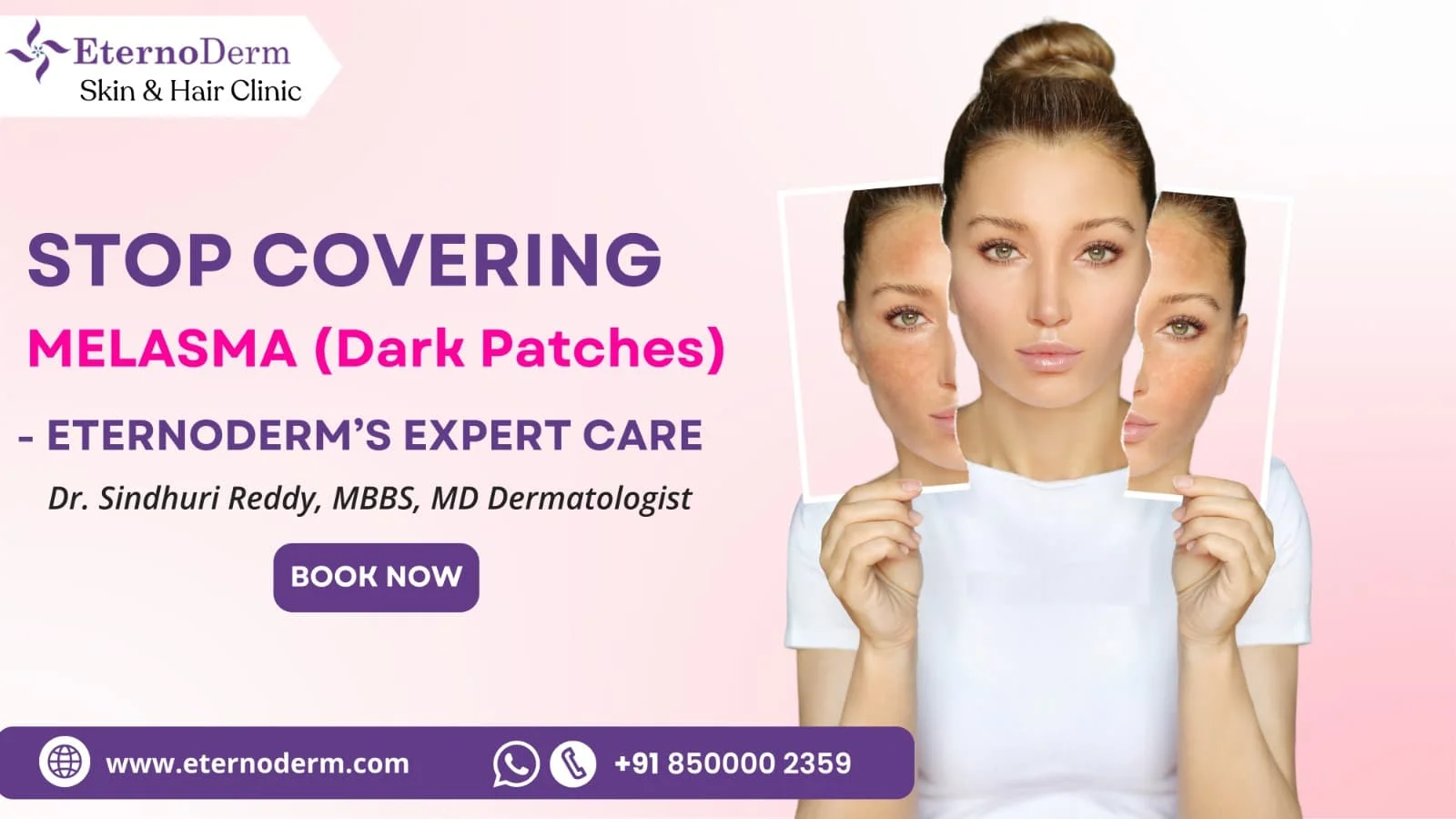 Woman with facial melasma dark patches showing before and after treatment results, EternoDerm Skin & Hair Clinic promotion.