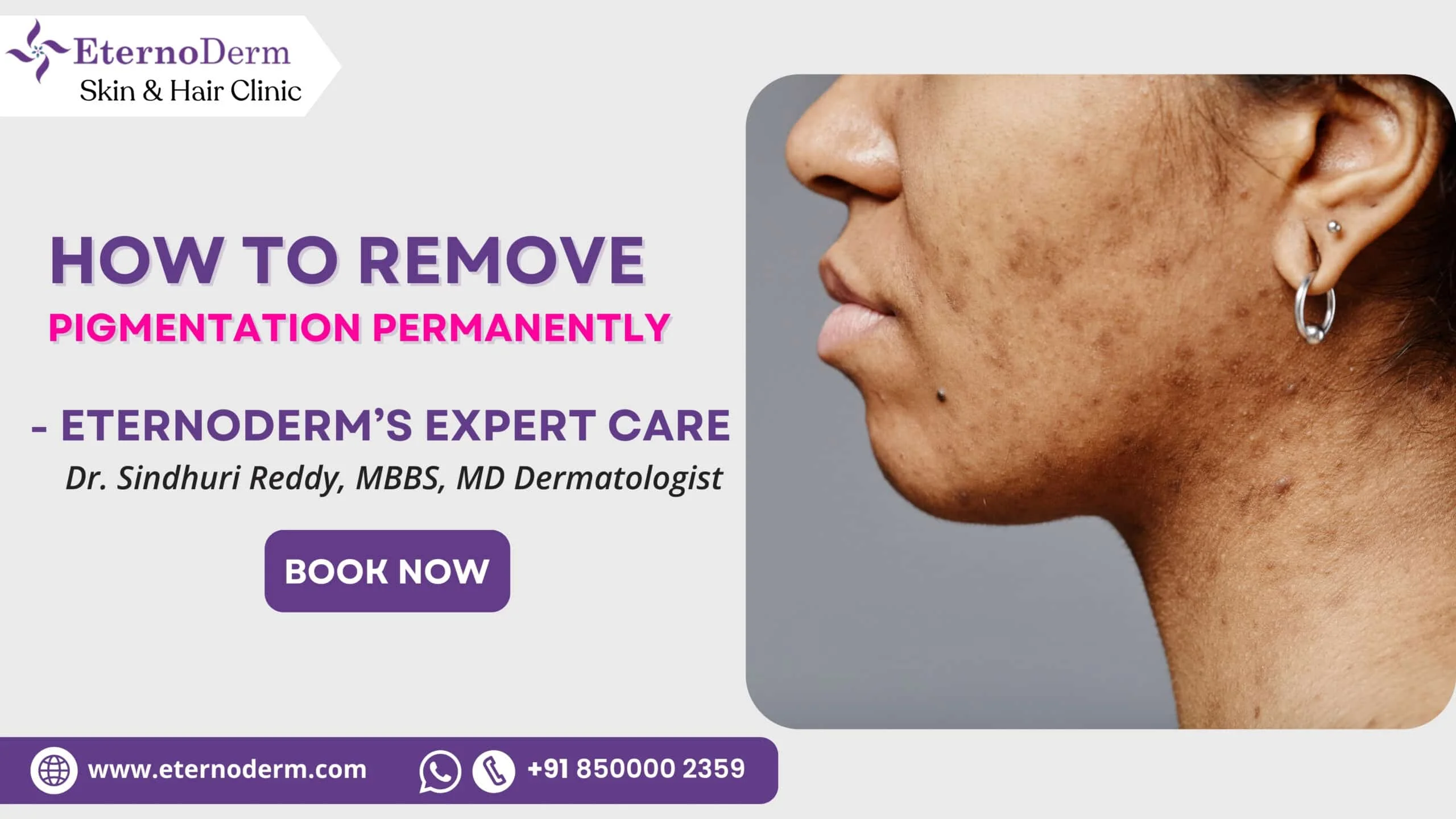 How to remove pigmentation permanently with dermatologist treatment in Miyapur Hyderabad