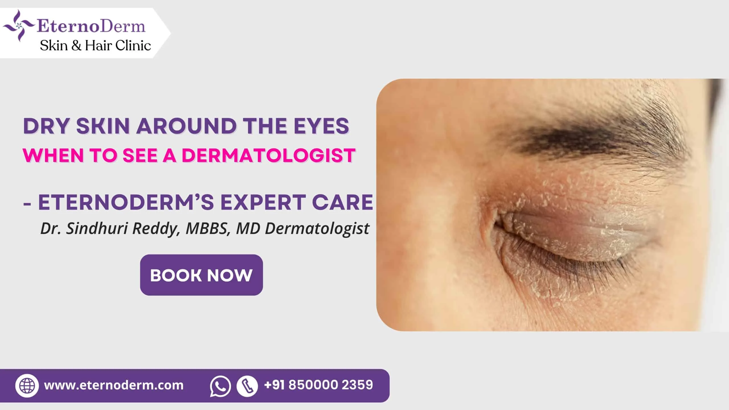 Dry skin around eyes treatment by dermatologist in Miyapur at EternoDerm Skin & Hair Clinic